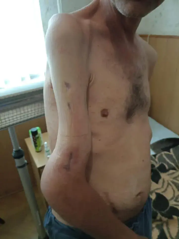 Ва ўкраінскага байца за месяцы расійскага палону не зраслася параненая рука