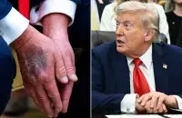 Сінякі на руках Трампа непакояць дактароў
