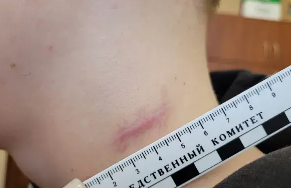 &nbsp;У потерпевших остались шрамы на лице и шее /&nbsp;sk.gov.by
