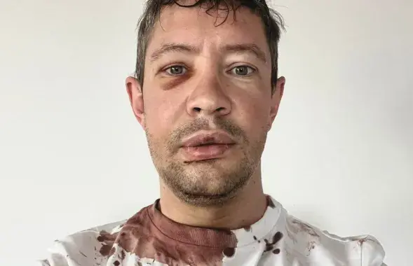 Аляксандр Канавалаў пасля збіцця невядомымі
